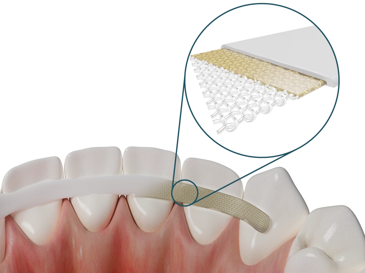Dentapreg® SFM – Dentapreg - ADM, a.s, Sonstige Schienen