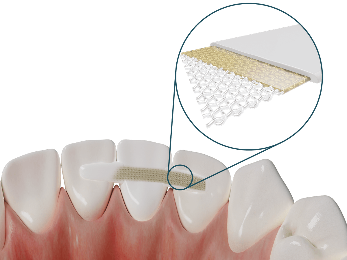 Dentapreg® PFM – ADM Dentapreg & Fibrafill, Provisorische Kronen