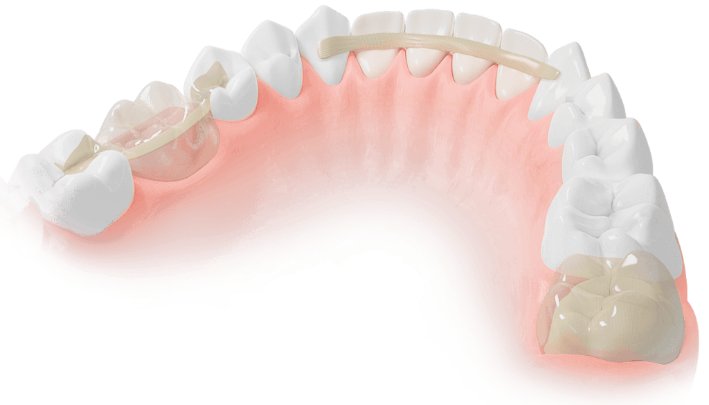 Dentapreg & Fibrafill – Dentapreg - ADM, a.s, Composites