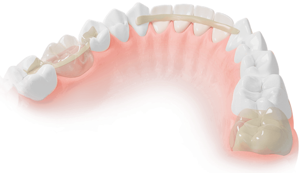 Dentapreg & Fibrafill