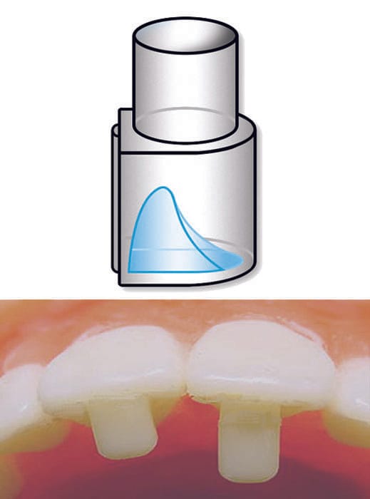 DYNAFLEX BITE-RAMP BONDER 2045-08 – Dynaflex Orthodontics USA, Sonstiges KFO