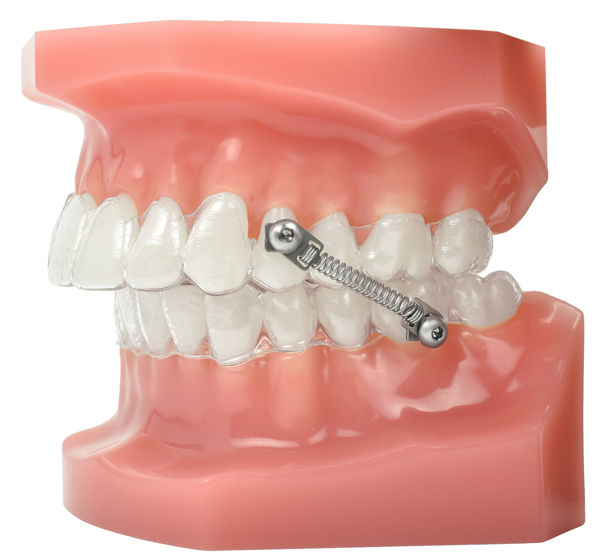 CS5 Bondable – Dynaflex Orthodontics USA, Attachments Adhäsivtechnik