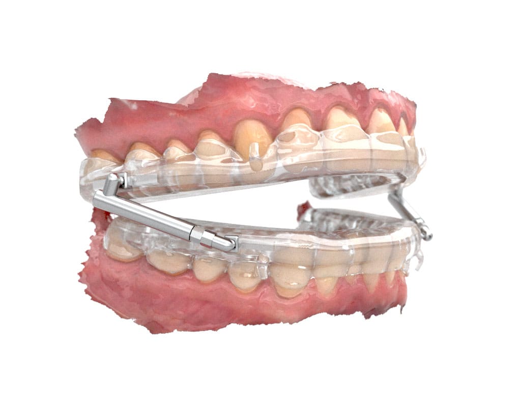 BioBiteCorrector® Sleep Appliance – BBC-Orthotec GmbH, Intraorale Geräte