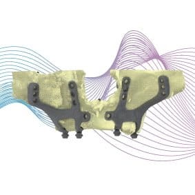 IUXTA IMPLANTS