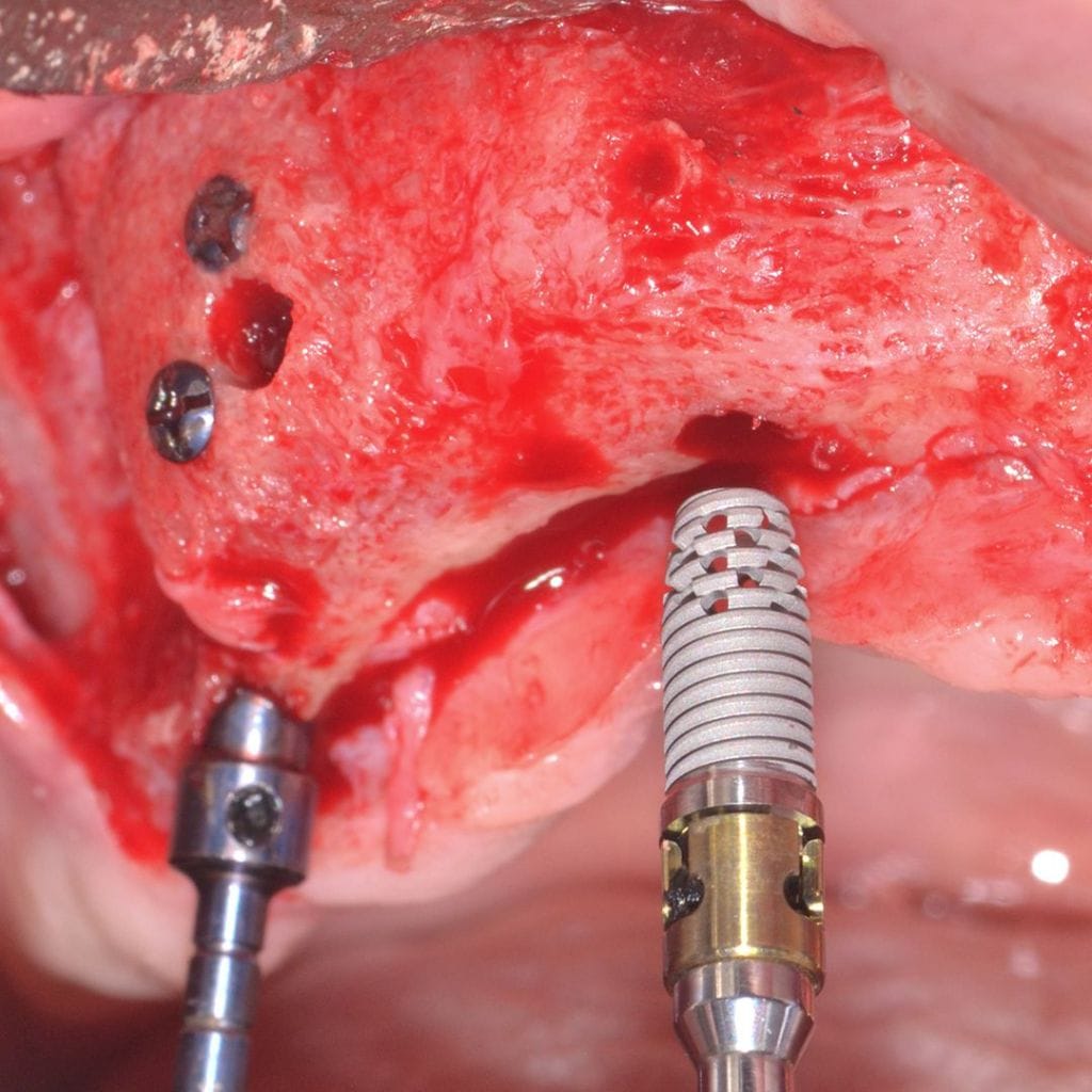Bonefill Porous Block – Bionnovation Biomedical, Knochenersatzmaterial