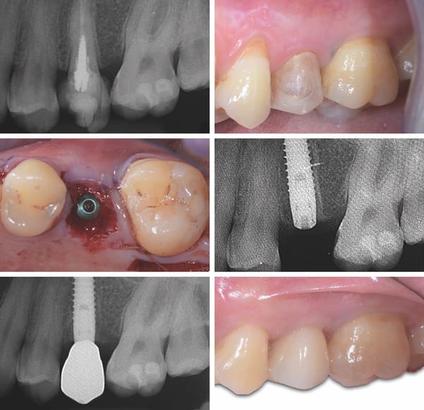 Implantate Linea KAPPA