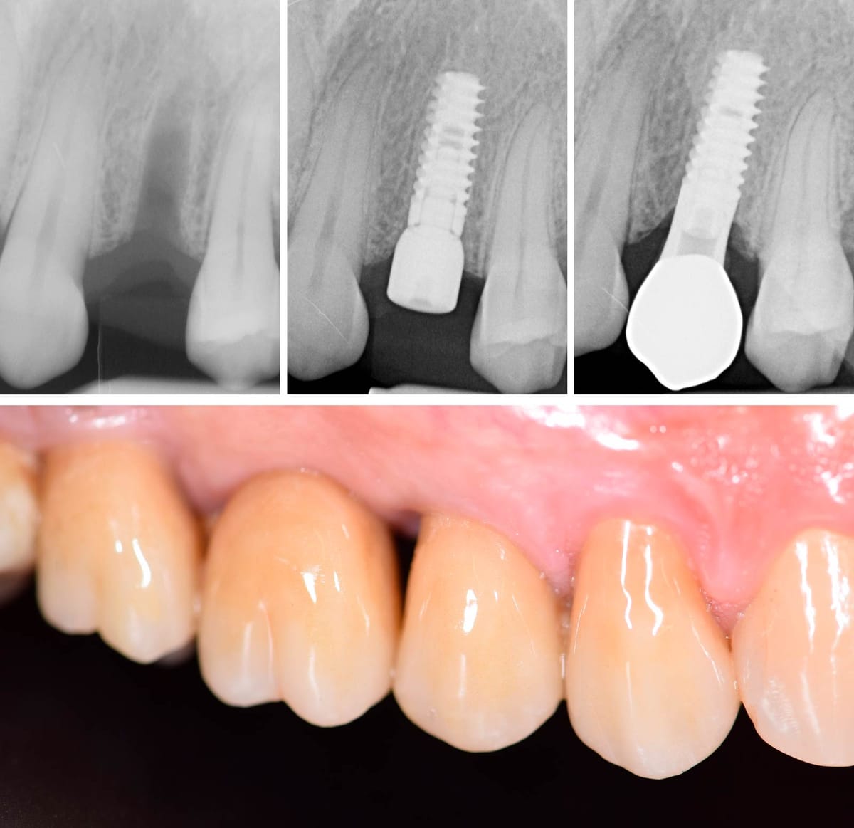 K25 Implant – BioSAF IN, Implantate