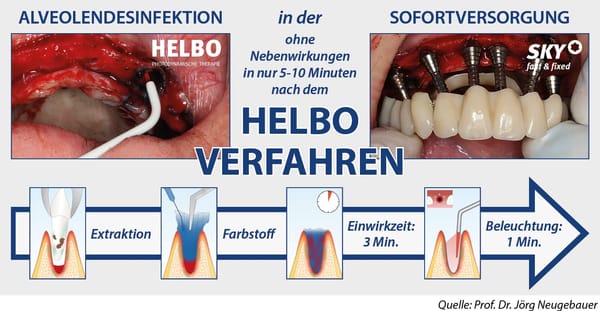 HELBO – Antimikrobielle Photodynamische Therapie
