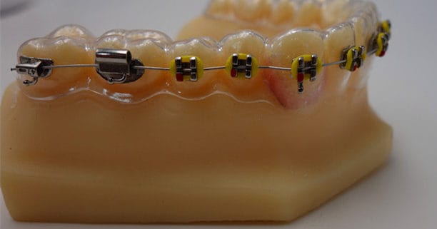 Clear Retainer with Brackets – China Orthodontic lab, Kieferorthopädie