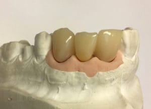 Dentalos Plus SG3a – DentalPlus, Kunststoffe