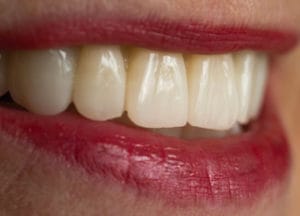 Dentalos Plus SG4a – DentalPlus, Kunststoffe