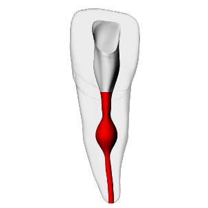 Incisor – Internal resorption, Radiopaque (White)