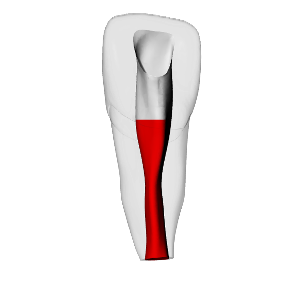 Incisor – Accessed, Open apex, Pulp