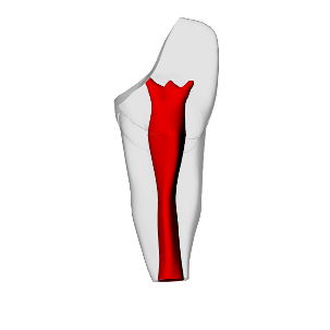 Incisor – Open apex, Pulp exposure