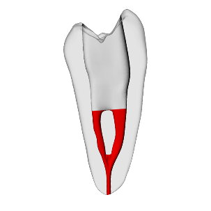 Premolar – Accessed, Merging canals, Clear, ~20#