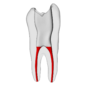 Premolar – Accessed, Conductive Canals, Clear