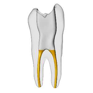 Premolar – Gutta percha, Clear