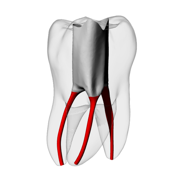 Molar – Accessed, Basic, Radiopaque (White)
