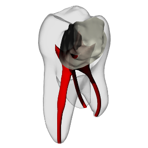 Molar – Pulp exposure, Clear