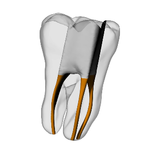 Molar – Accessed, Gutta percha, Clear