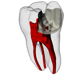 Molar – Pulp exposure, Carious lesion, Radiopaque (White)