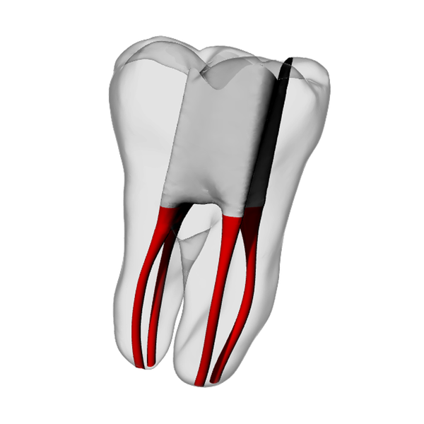 Molar – Accessed, Four canals, White
