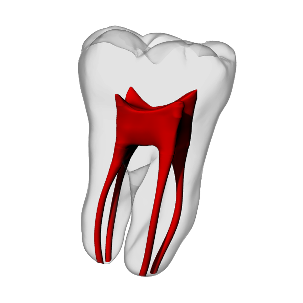 Molar – Four canals, Clear Root, White Crown, ~20#
