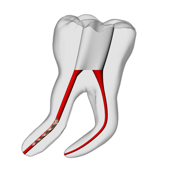 Molar – 6mm Broken File, 30° Distal Canal