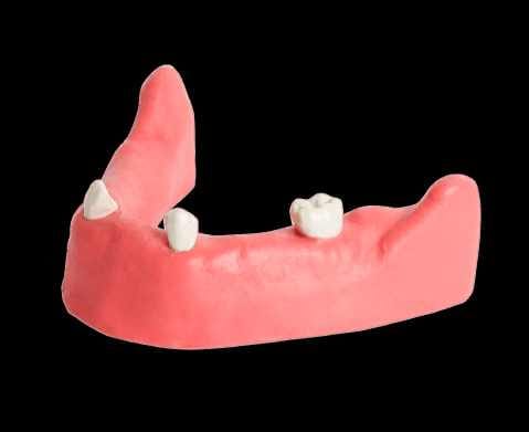 Teilbezahnte Modelle für Implantat-Übungen