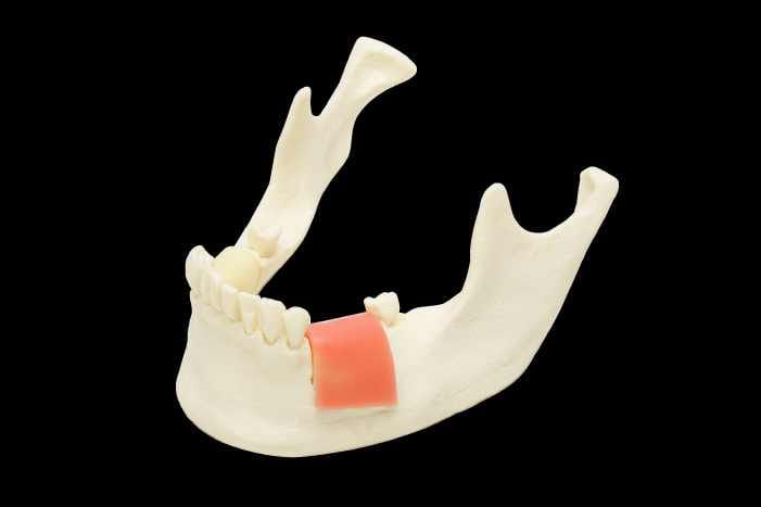Modell für Implantatinsertion mit auswechselbaren Knochenblöcken unterschiedlicher Knochendichte – Navadha Enterprises, Geräte