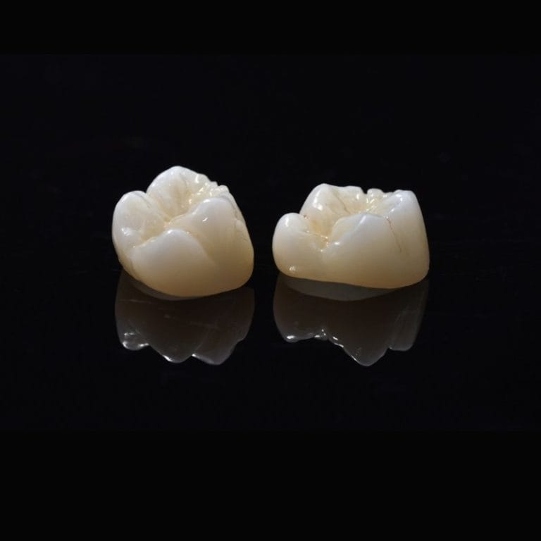 Zirconia Crowns – Krausz Dental Lab, Provisorische Kronen