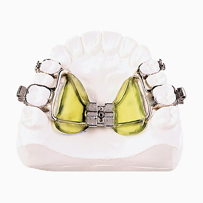 Haas Palatal Seperator EX/01 – lab3d, Intraorale Geräte