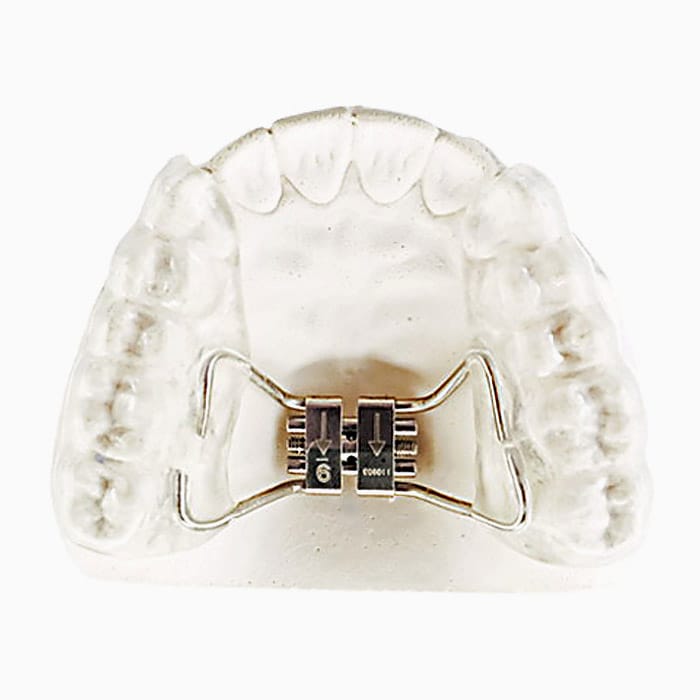 Bonded Rapid Palatal Expander EX/02 – lab3d, Sonstige Schienen