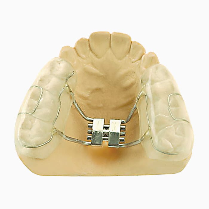 Bonded Rapid Palatal Expander EX/03 – lab3d, Sonstige Schienen
