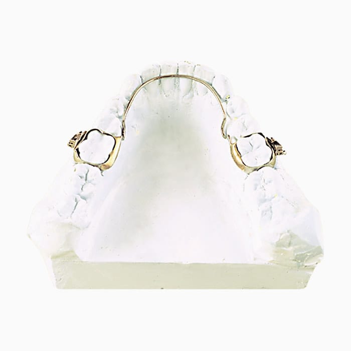 Lingual Arch HO/02 – lab3d, Lingualbögen