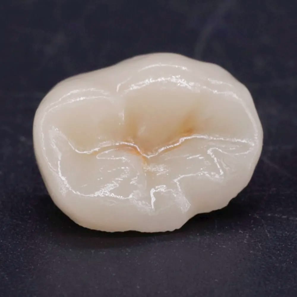 Inlay - Onley - Overlay CA/25 – lab3d, Lithium-Disilikat