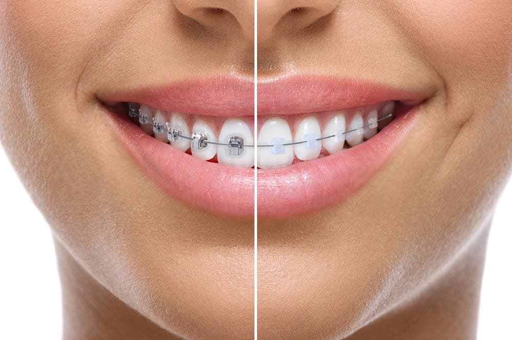 GENIUS SYSTEM Mobile FR – Ortho Partner, Brackets