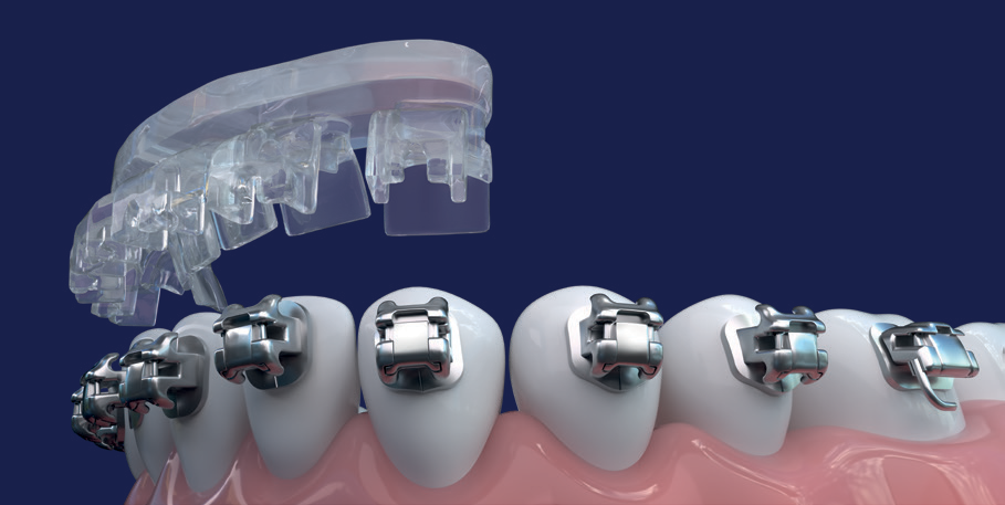 Damon Q2 Brackets – Ormco, Brackets