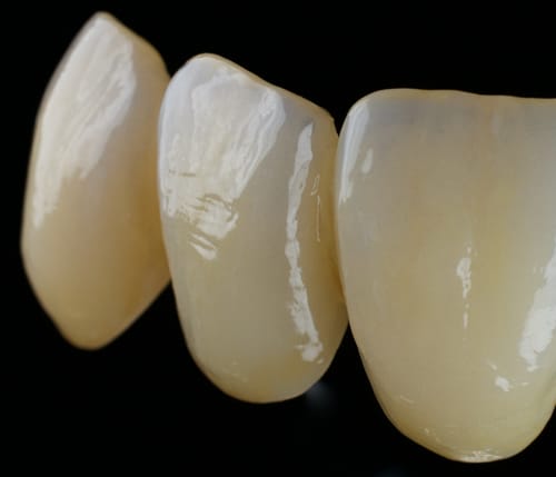 priti®perfect – Pritidenta GmbH, Keramikmassen