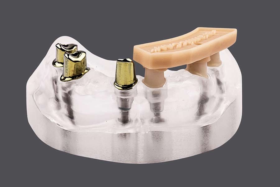 Individuelle Abutments – seramicCAM Europa GmbH, Abutments