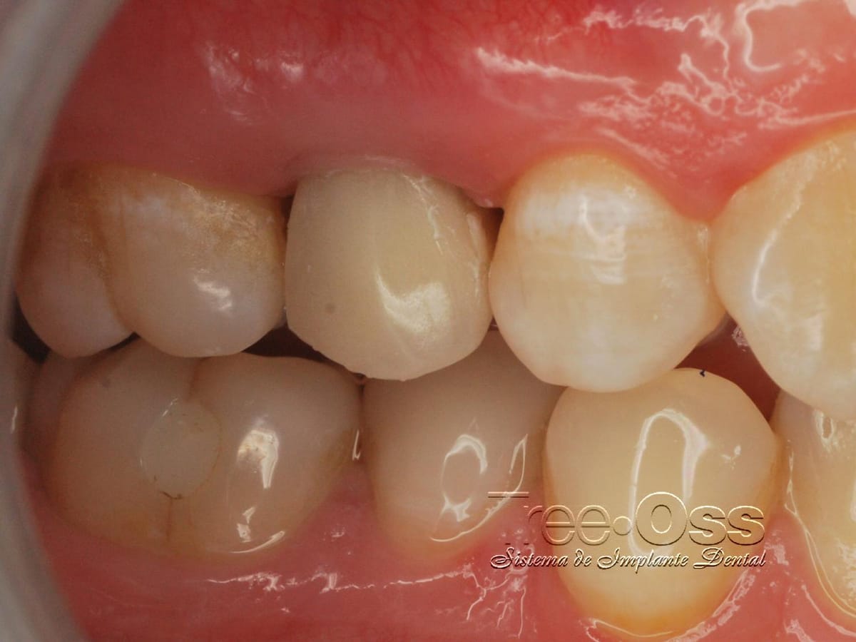 Tree•Oss HS – Tree-Oss S.R.L., Implantate