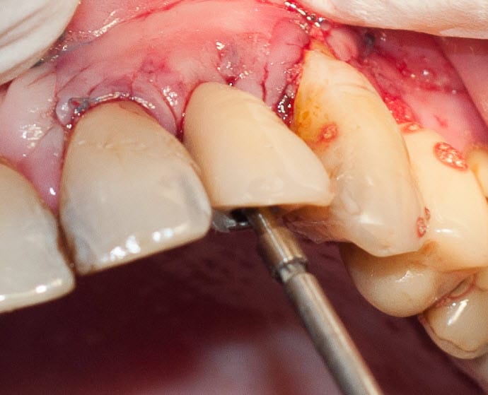 Tree·Oss SIMPLE – Tapered Implant with simplified technique internal hex connection – Tree-Oss S.R.L., Implantate