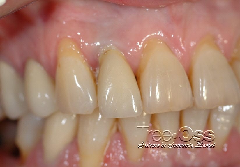 Tree•Oss ANATOMIC – External Connection – Tree-Oss S.R.L., Implantate