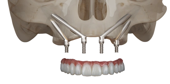 Protesica Zygoma+ – Biologitech Srl, Abutments
