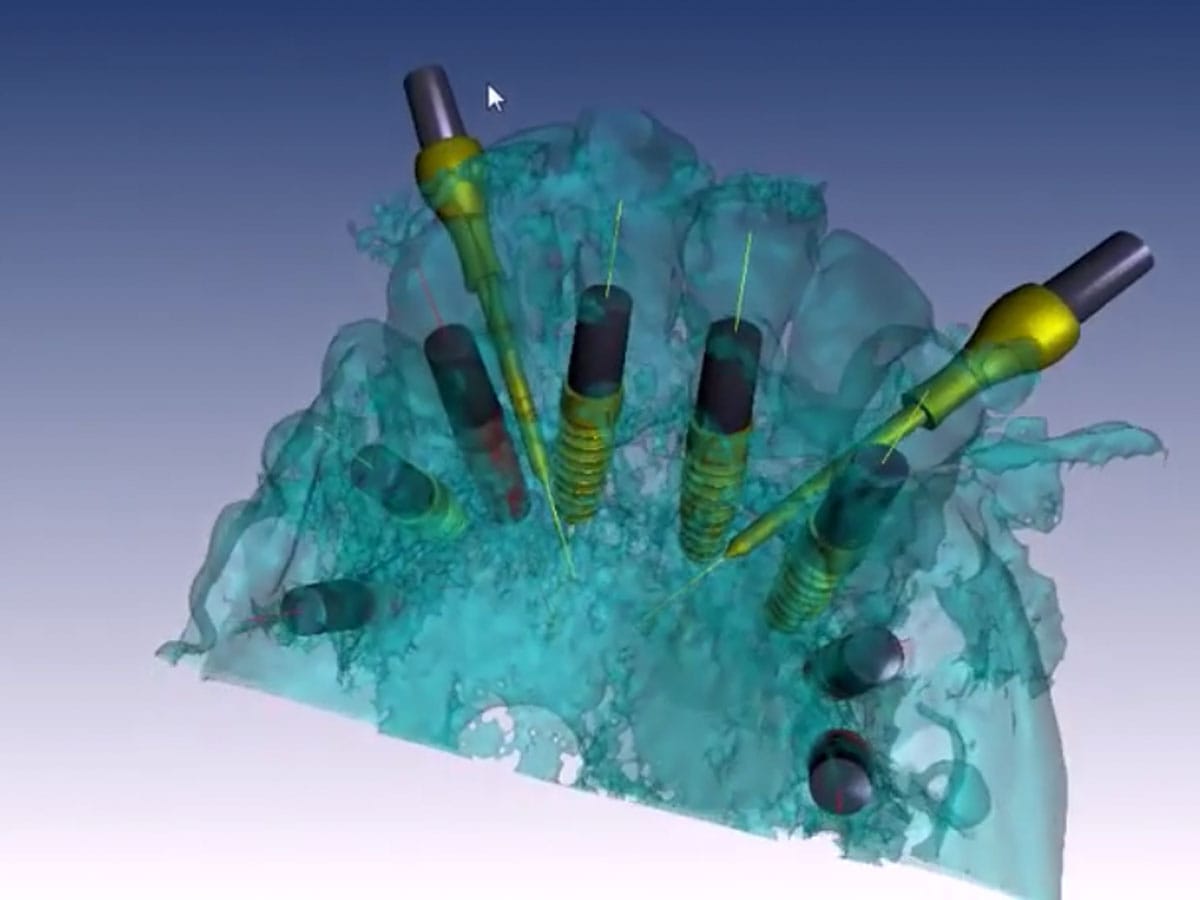 BNX 3D Guide – Ghimas S.p.A., Bohrschablone