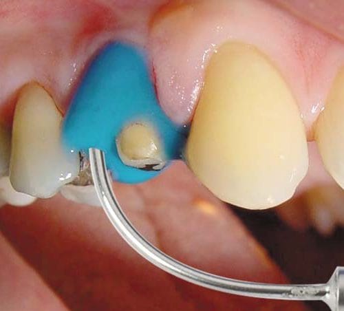 Algiloid®