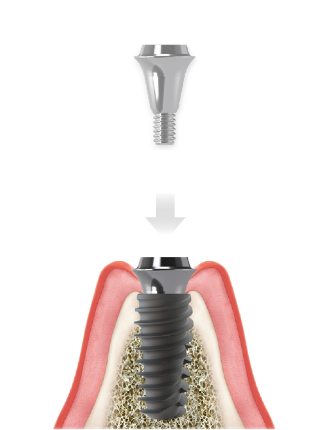 Highness Implant-System Digitale Prothetik – Highness Implant System, Sonstiges