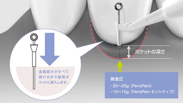PerioPam