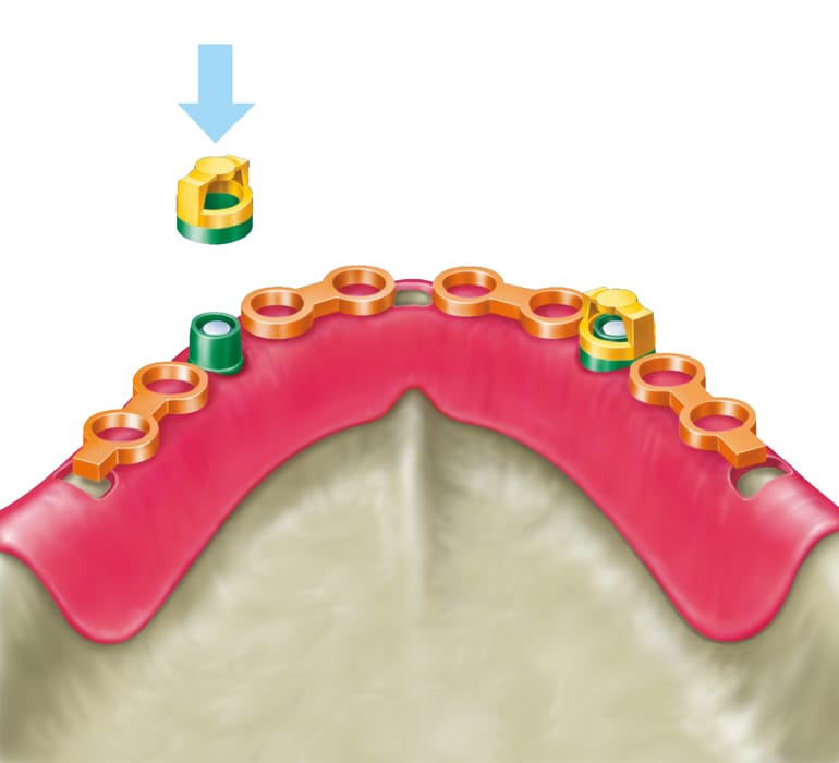 Basisprofile für Kugelanker – Servo-Dental, Geschiebe