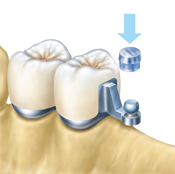 Kugelanker horizontal – Servo-Dental, Geschiebe